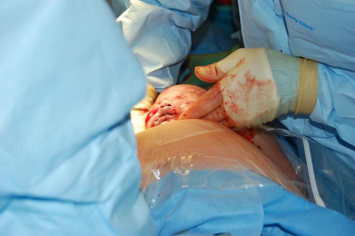 Vaginal Birth After Cesarean Section (VBAC)