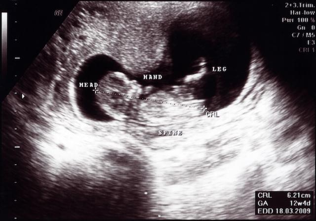 dating ultrasound at 35 weeks