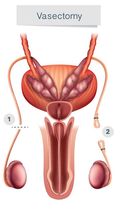 https://www.babymed.com/sites/default/files/styles/large_blog_post_image/public/vasectomy-male-contraception%201440_1_0.jpg?itok=z7hT9nTt